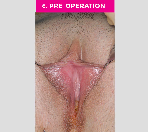 CLITORAL HOOD REDUCTION WITH/WITHOUT CLITOROPEXY Patient 5 Before 2