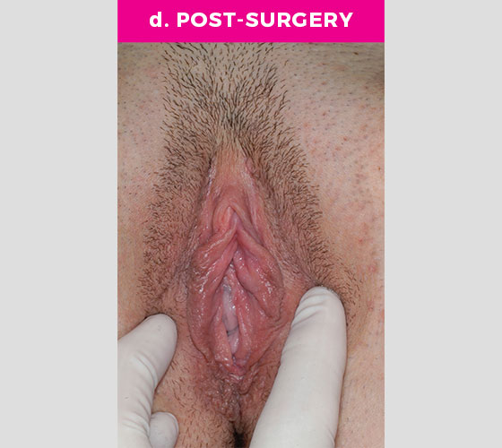 CLITORAL HOOD REDUCTION WITH/WITHOUT CLITOROPEXY Patient 5 After 2