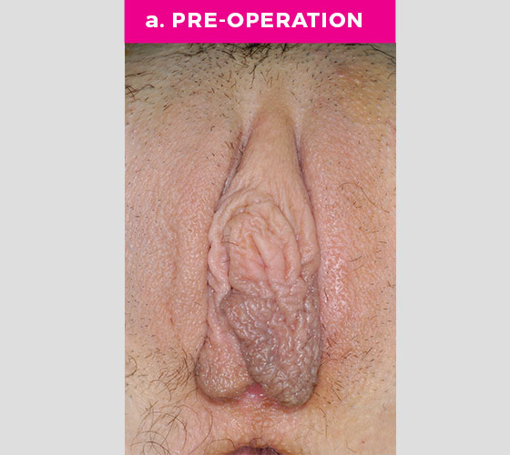 CLITORAL HOOD REDUCTION WITH/WITHOUT CLITOROPEXY Patient 7 Before
