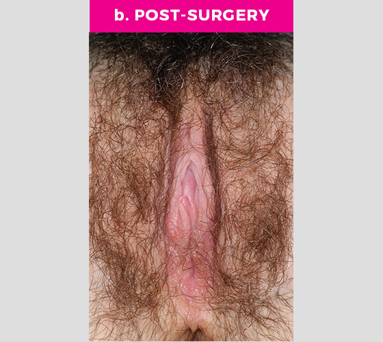 CLITORAL HOOD REDUCTION WITH/WITHOUT CLITOROPEXY Patient 7 After