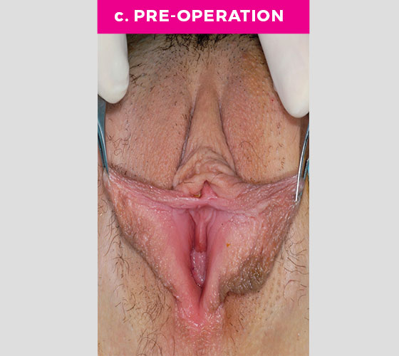CLITORAL HOOD REDUCTION WITH/WITHOUT CLITOROPEXY Patient 7 Before 2