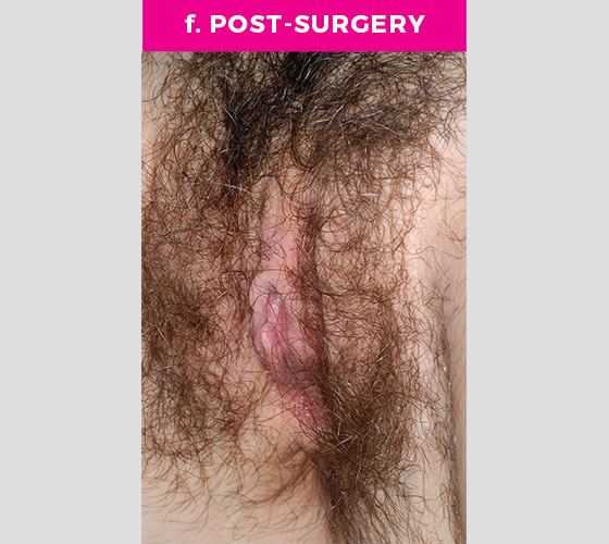 CLITORAL HOOD REDUCTION WITH/WITHOUT CLITOROPEXY Patient 7 After 3