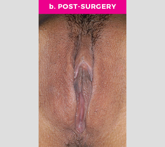 CLITORAL HOOD REDUCTION WITH/WITHOUT CLITOROPEXY Patient 8 After