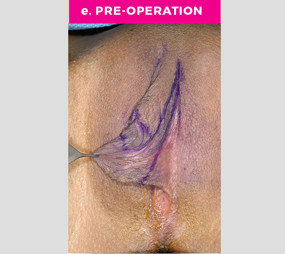 CLITORAL HOOD REDUCTION WITH/WITHOUT CLITOROPEXY Patient 8 Before 3