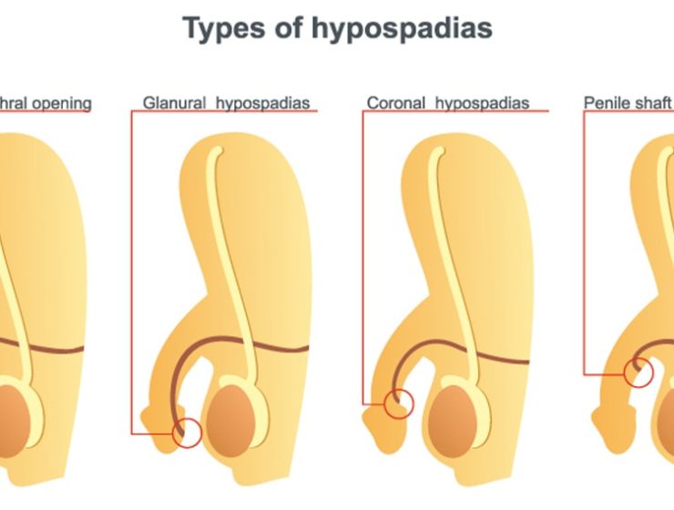 Illustration of types of hypospadias.