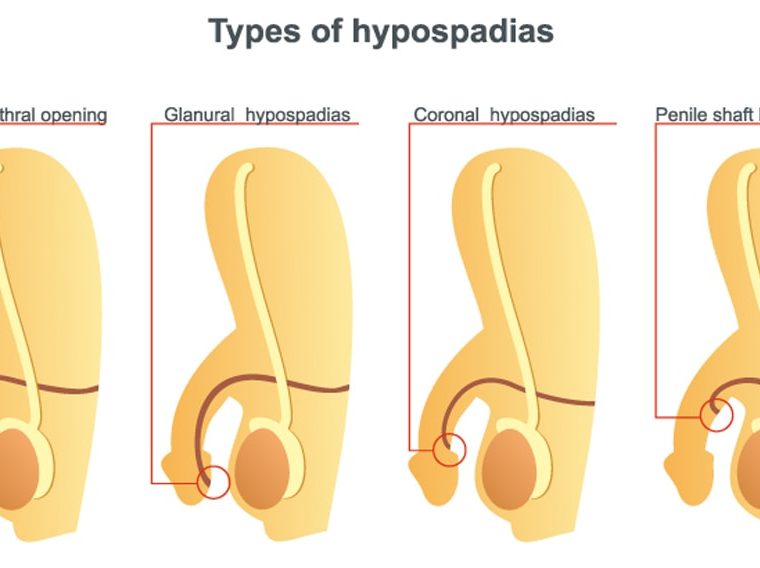 Illustration of types of hypospadias.