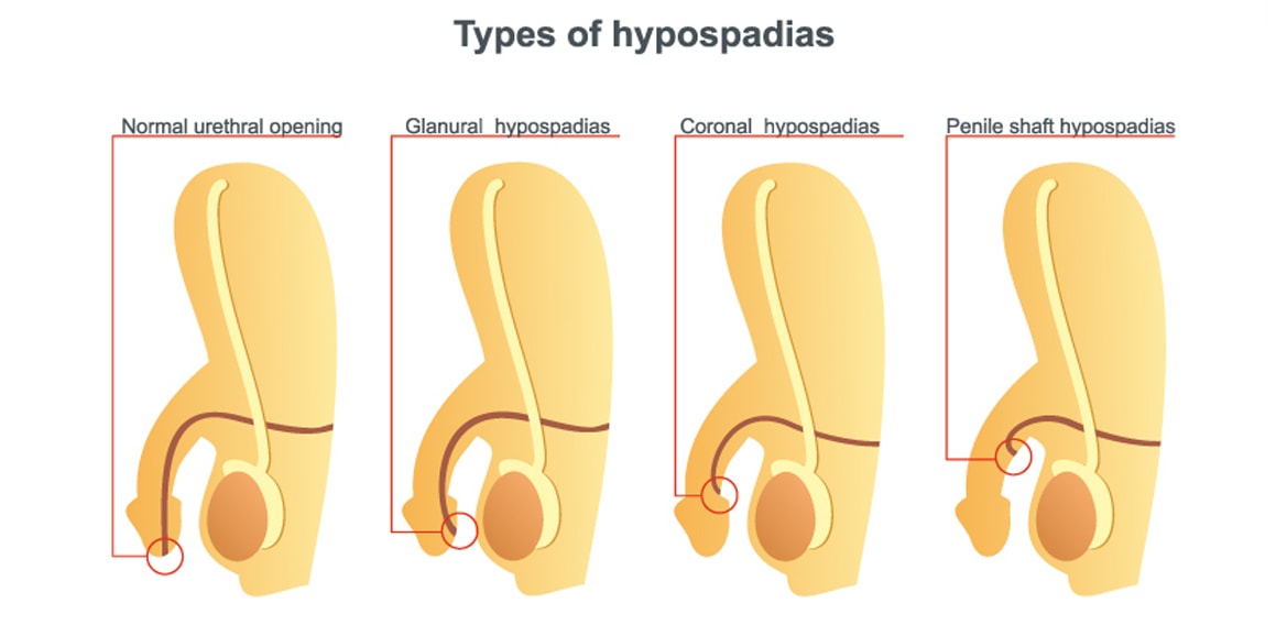 Illustration of types of hypospadias.