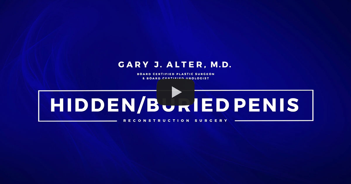 Video link: Hidden/Buried Penis - Male Genital Surgery